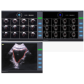 Bladder Ultrasound Scanner wireless